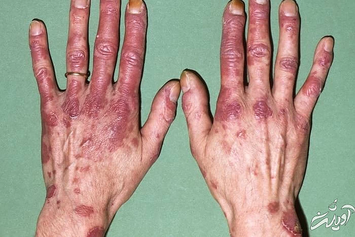 روز جهانی بیماری لوپوس لوپوس